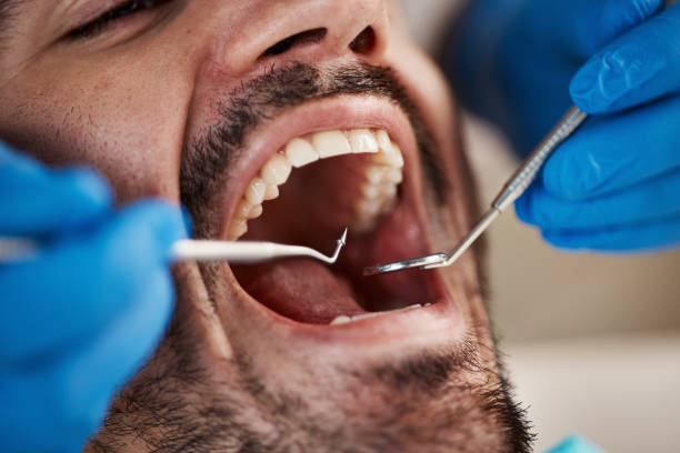 Best Knocked-Out Tooth (Avulsed Tooth) Treatment in Las Maravillas, NM